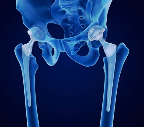 Benefits Of Anterior Hip Replacement Hip Pain Phoenix Spine And Joint