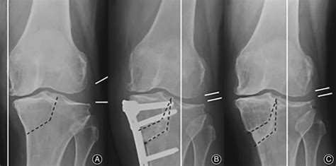 Osteotomy Around The Knee The Surgical Treatment Of Osteoarthritis