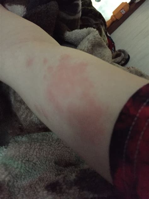 Weird Rash On My Arm Glow Community