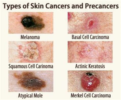Skin Cancer Types Basal Cell Carcinoma Bcc Squamous Cell Carcinoma Scc Melanoma St Louis Mo
