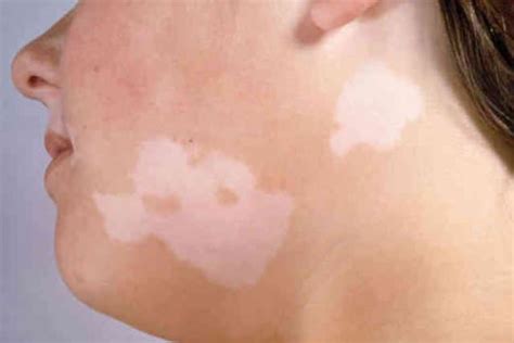 White Spots On Skin What Causes White Spots On Skin Images And Photos Finder