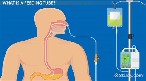 What Is A Feeding Tube Types And Complications Lesson