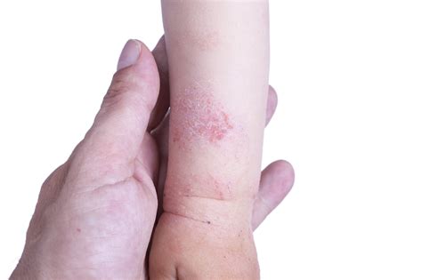 Dermatit Atopic La Bebelu I Cauze Simptome Tratament Spectra Romania