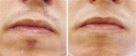 Laser Hair Removal Upper Lip Cost Reviews How Many Treatments And Side Effects Of Upper Lip Hair