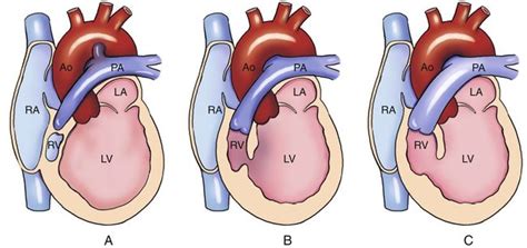 Hypoplasia Of The Right Ventricle Radiology Key