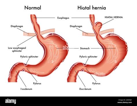 Hiatal Hernia Hiatal Hernia And Normal Anatomy Of The Stomach Stock