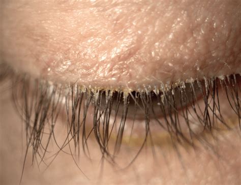 Ed Holland Asks If Demodex Blepharitis Treatment Is The Next Big Thing