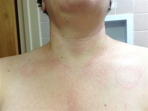 I Am A 44 Years Old Who Was Diagnosed With Tinea Versicolor