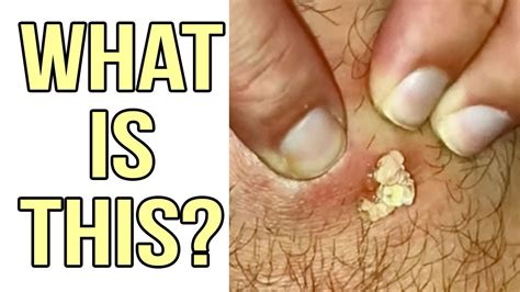 What Are Epidermoid Cysts Amazing Examples With Explanation Youtube