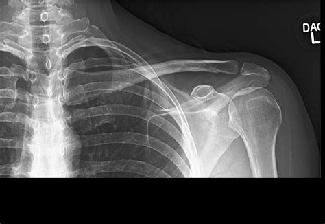 Ortho Dx Swelling Around The Clavicle Clinical Advisor