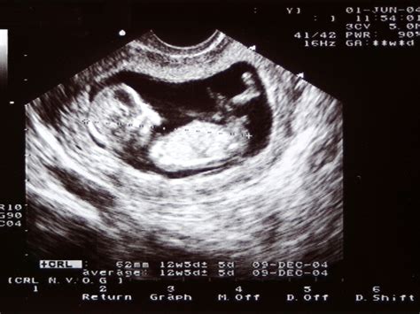 Dating Scan At 8 Weeks