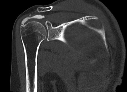 Calcific Tendinitis Of The Supraspinatus Tendon Radiology Case