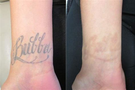 Each pulse of energy penetrates the. Tatoo removal laser - blog