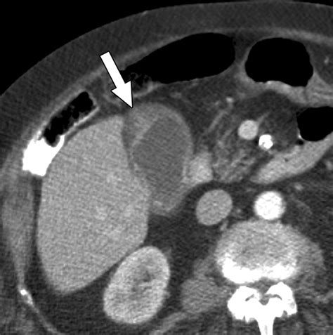 Ct Differentiation Of Adenomyomatosis And Gallbladder Cancer Ajr