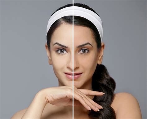 How To Treat Uneven Skin Tone Naturally Learn More About How To Get