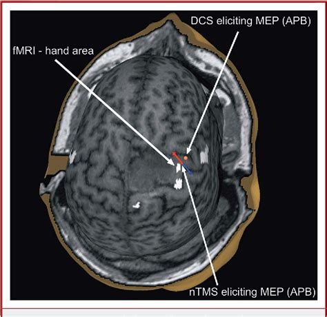 Figure 1 From Navigated Transcranial Magnetic Stimulation And