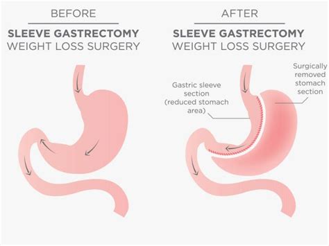 Laparoscopic Sleeve Gastrectomy Surgery Gold Coast
