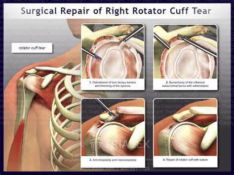 Surgical Repair Of The Right Rotator Cuff Tear Trialexhibits Inc