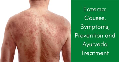 Eczema Causes Symptoms Prevention And Ayurvedic Treatment