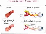 Optic Nerve Neuropathy Treatment
