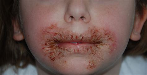 Baby Wipes Causing Itchy Scaly Rashes In Some Babies Photo Courtesy