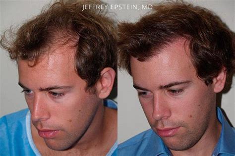 Hair Transplants For Men Photos Miami Fl Patient38683