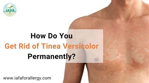 How Do You Get Rid Of Tinea Versicolor Permanently