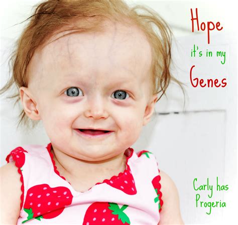Progeria Hgps Syndrome De Hutchinson Gilford