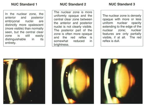 How To Diagnose And Grade Cataracts Eyeguru