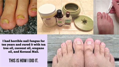 I Had Horrible Nail Fungus For Ten Years And Cured It With Tea Tree Oil