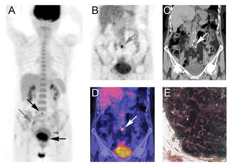 Lymph Node Assessment With 18f Fdg Pet And Mri In Uterine Cervical Cancer