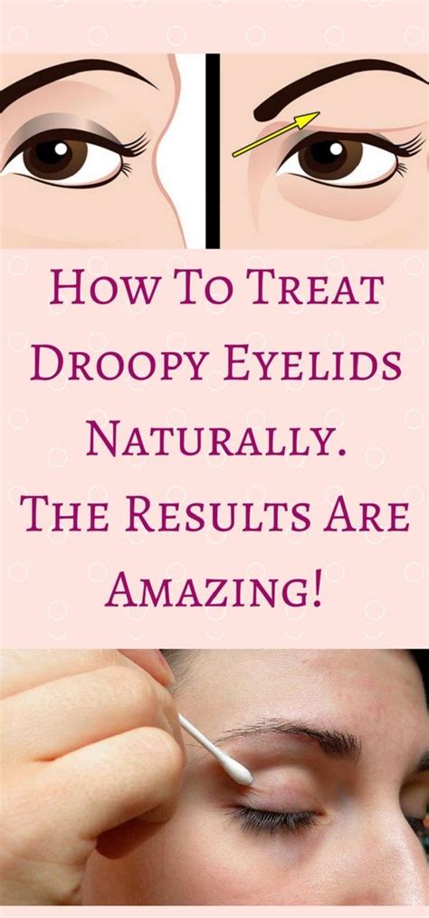 How To Treat Droopy Eyelids Naturally The Results Are Amazing Diy