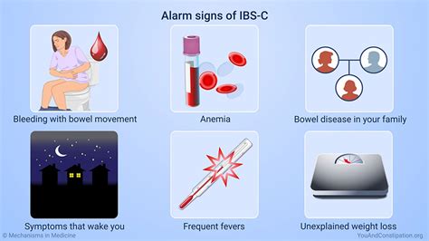 Slide Show Diagnosing Ibs With Constipation