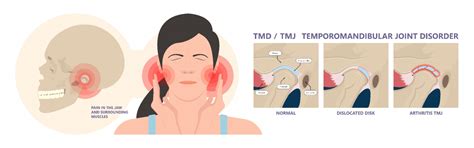 Temporomandibular Joint Disorders Causes Symptoms And Treatment