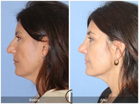 Female Rhinoplasty Before And After Photos Patient 55 Dr Kevin Sadati