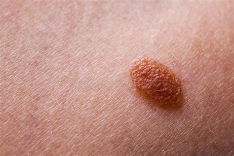Closeup Brown Mole On Caucasian Woman Skin Stock Photo Image Of