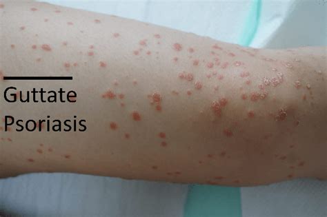 Warnings 6 Types Of Psoriasis And 4 Skin Conditions You Need To Know