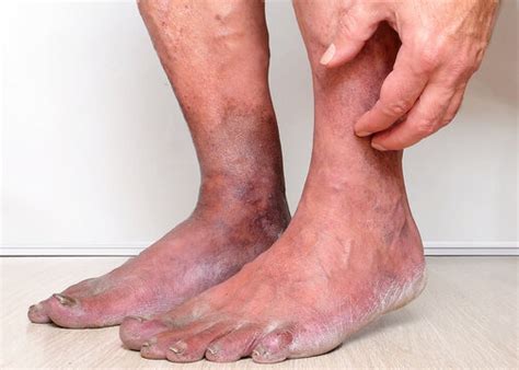 Phlebitis Foot
