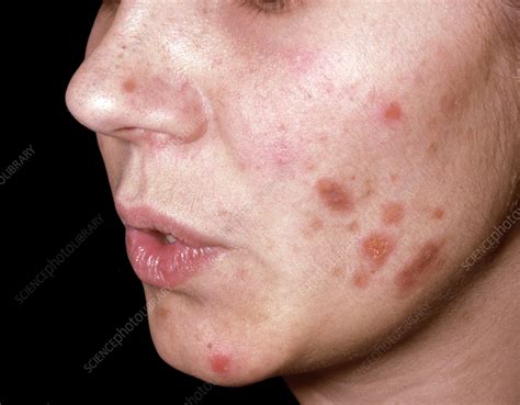 Nodular Prurigo On A Womans Face Stock Image C0580560 Science