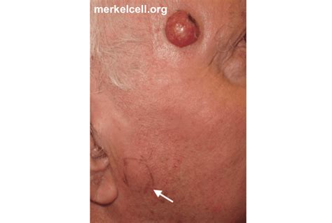 It's a type of skin cancer that occurs when cells in the skin, known as merkel cells, grow uncontrollably. Clinical Photos of Merkel Cell Carcinoma