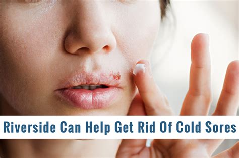 How To Treat Cold Sores On Lips