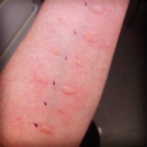 Allergy Testing Im Getting Some Pretty Amazing Welts This Year