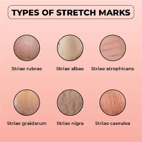 Stretch Marks Treatment In Hyderabad Stretch Marks Removal