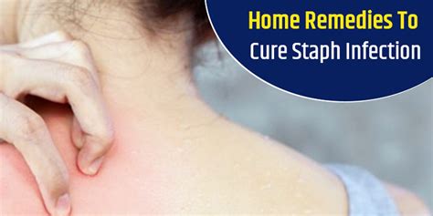 Try Out These 5 Home Remedies To Cure Staph Infection Onlymyhealth