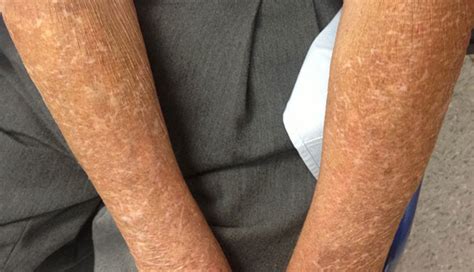Derm Dx White Spots On Sun Damaged Skin Clinical Advisor