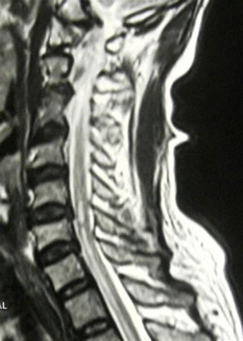 Arteria Spinalis Anterior Syndrom Anterior Cord Syndrom E Learning