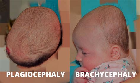 Pediatric Therapy For Plagiocephaly Lake Forest Il The Baby