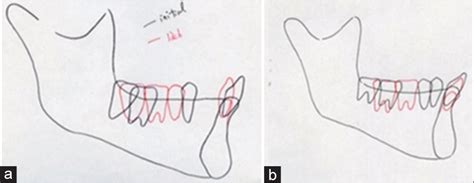 Molar Protraction And Uprighting 2 Molar Protraction In The 1 Molar