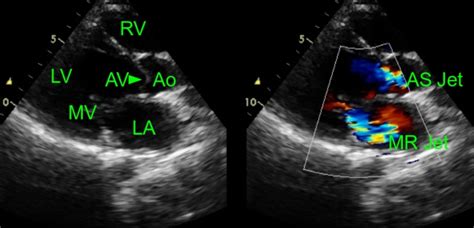 Mitral Regurgitation With Aortic Stenosis Echocardiogram