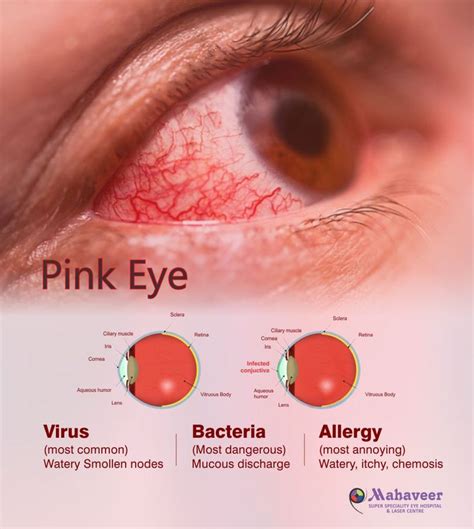 Pink Eyes Healthy Eyes Allergies